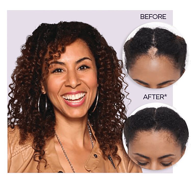 Hair Regrowth Treatment for Women