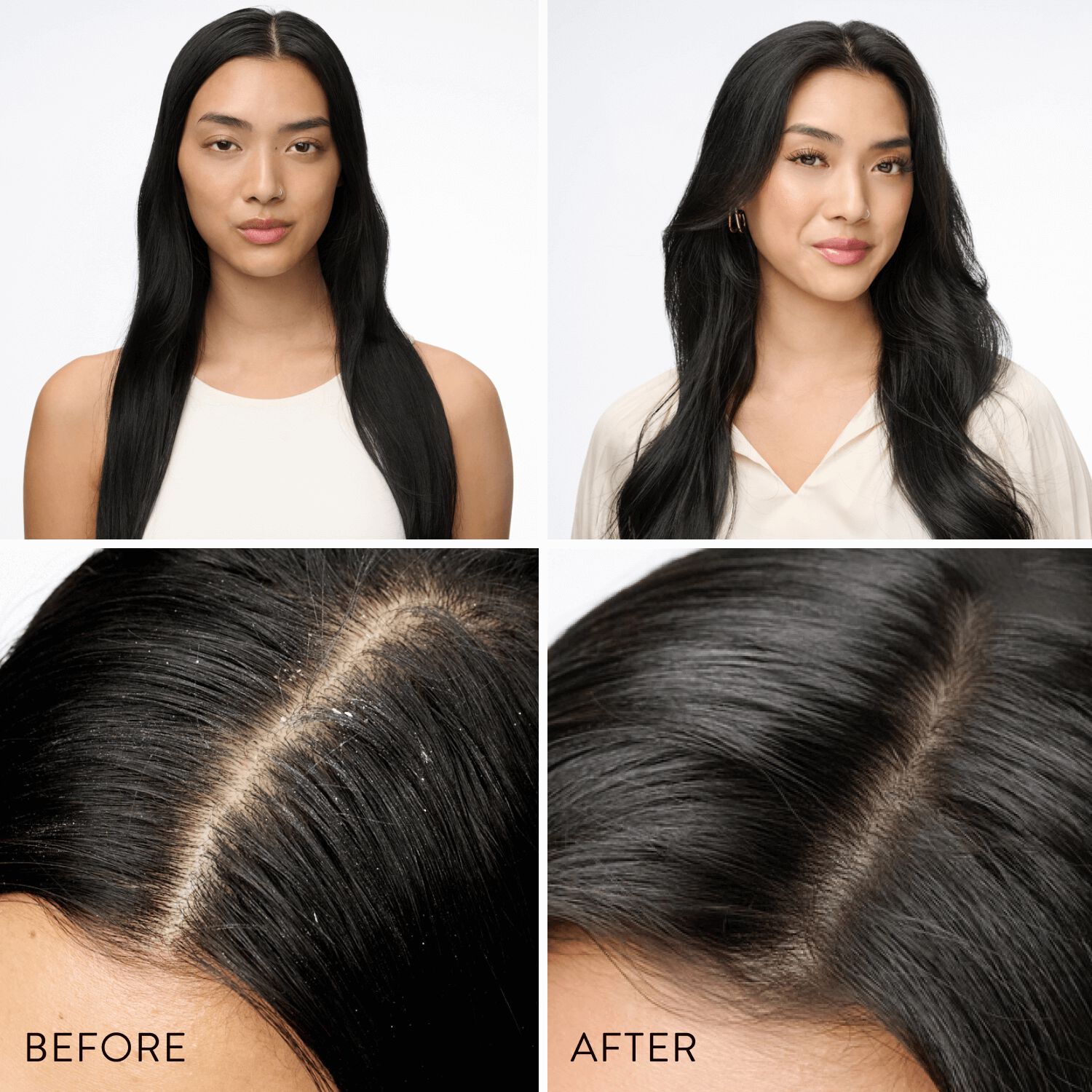 how to prevent dandruff